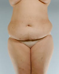Tummy Tuck Before & After Gallery - Patient 251377 - Image 1