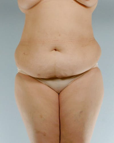 Tummy Tuck Before & After Gallery - Patient 251377 - Image 1