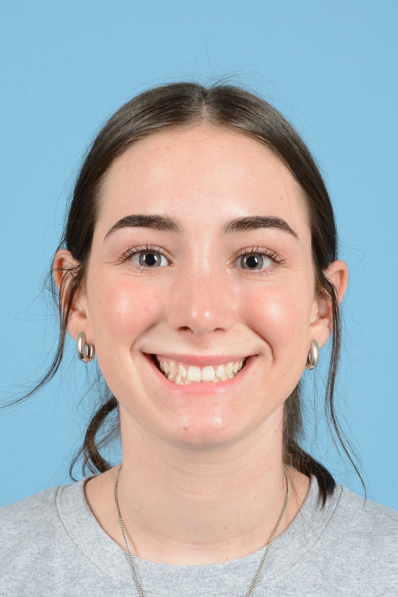 Rhinoplasty Before & After Gallery - Patient 126984 - Image 4