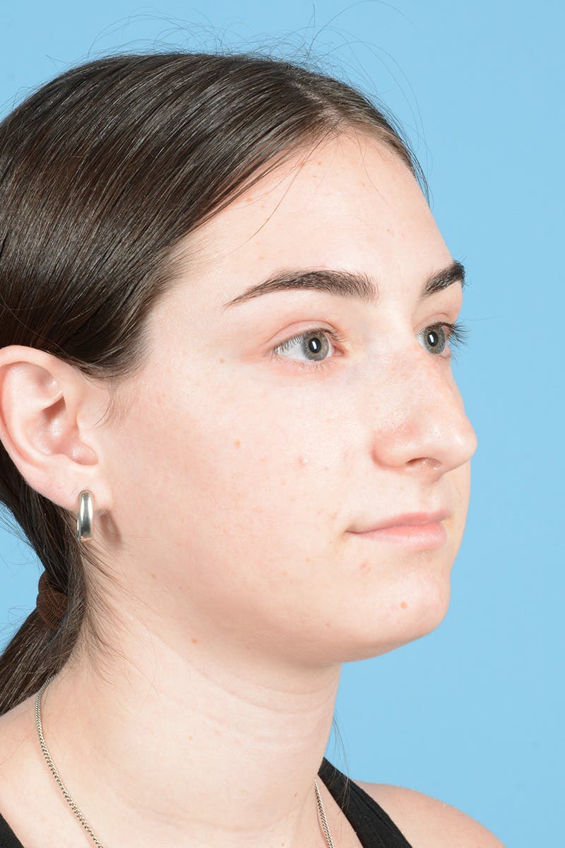 Rhinoplasty Before & After Gallery - Patient 126984 - Image 5