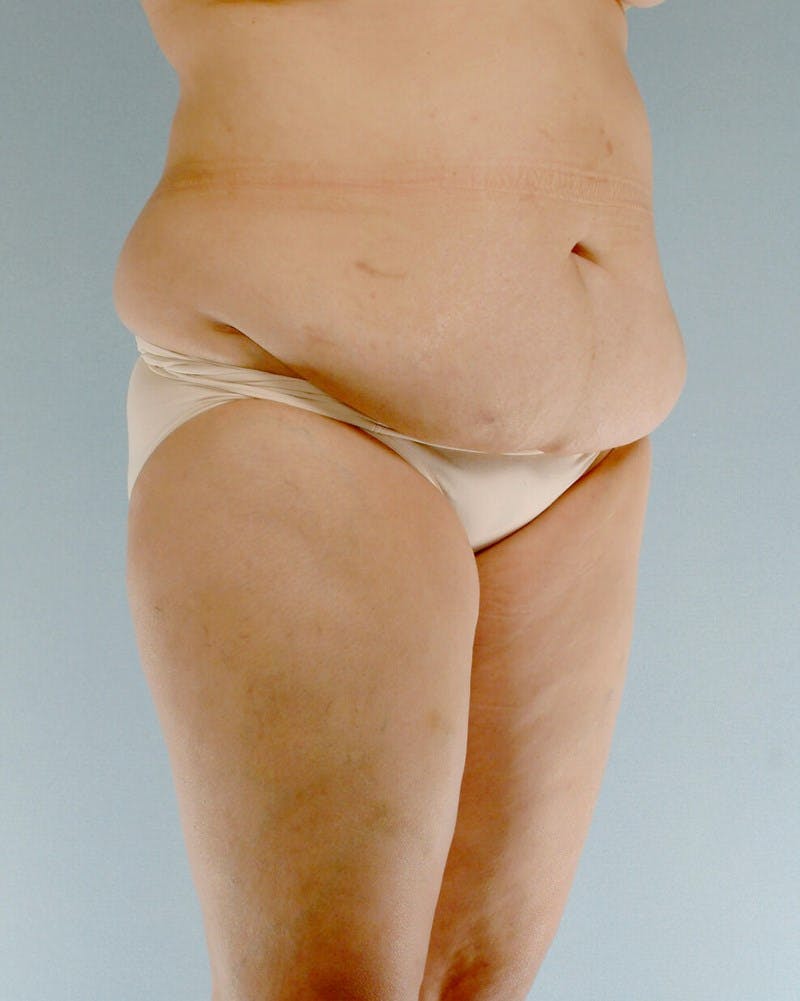 Tummy Tuck Before & After Gallery - Patient 251377 - Image 3