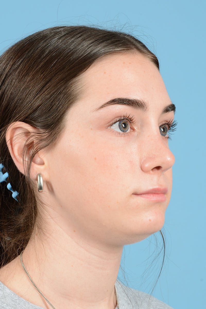 Rhinoplasty Before & After Gallery - Patient 126984 - Image 6