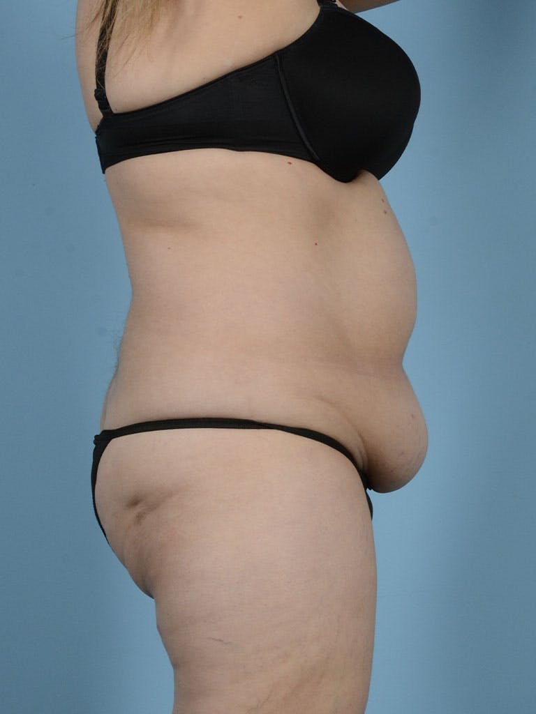 Liposuction Before & After Gallery - Patient 296496 - Image 9