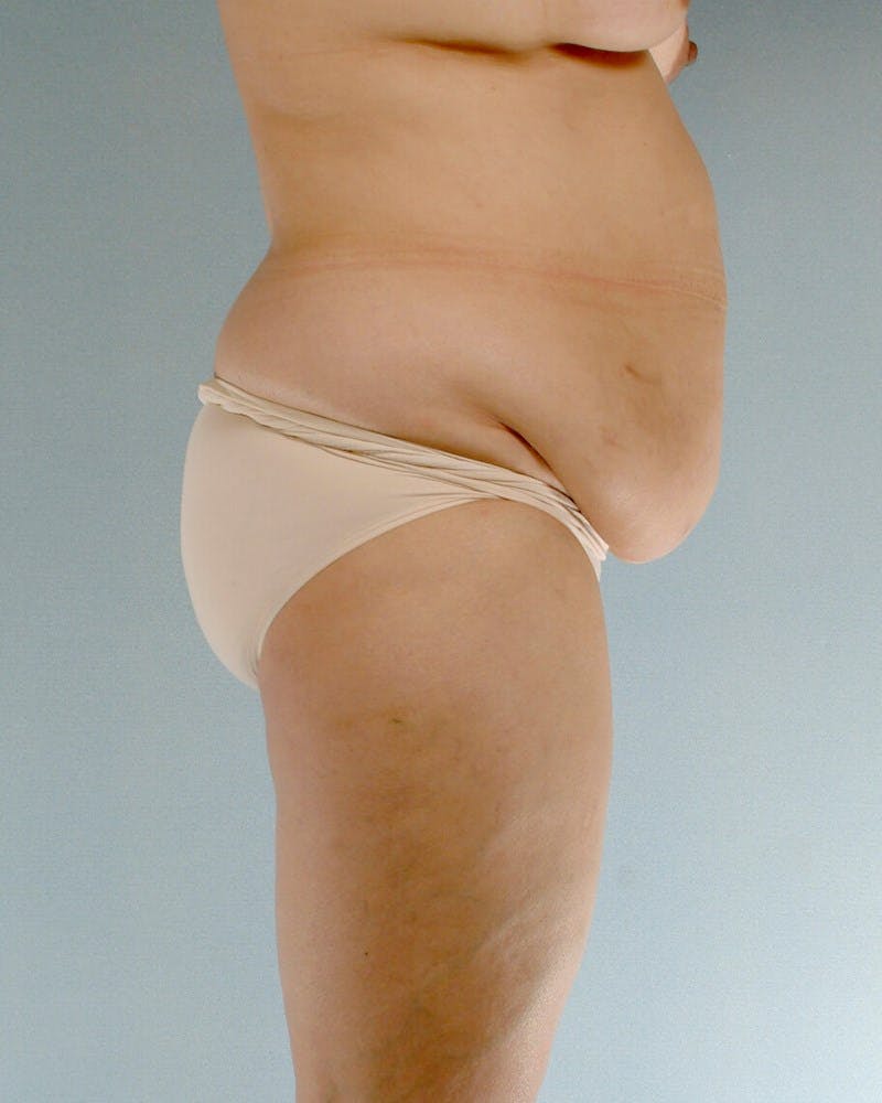 Tummy Tuck Before & After Gallery - Patient 251377 - Image 5