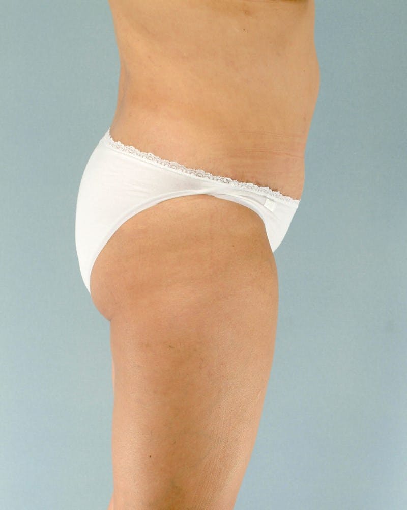 Tummy Tuck Before & After Gallery - Patient 251377 - Image 6