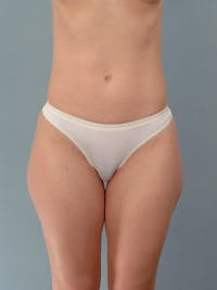 Liposuction Before & After Gallery - Patient 401997 - Image 1