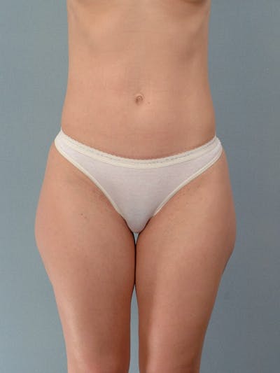 Liposuction Before & After Gallery - Patient 401997 - Image 1