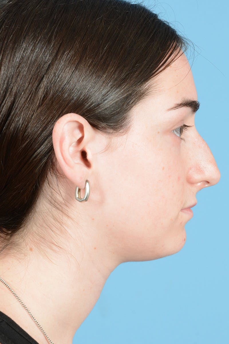 Rhinoplasty Before & After Gallery - Patient 126984 - Image 8