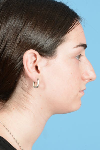 Rhinoplasty Before & After Gallery - Patient 126984 - Image 8