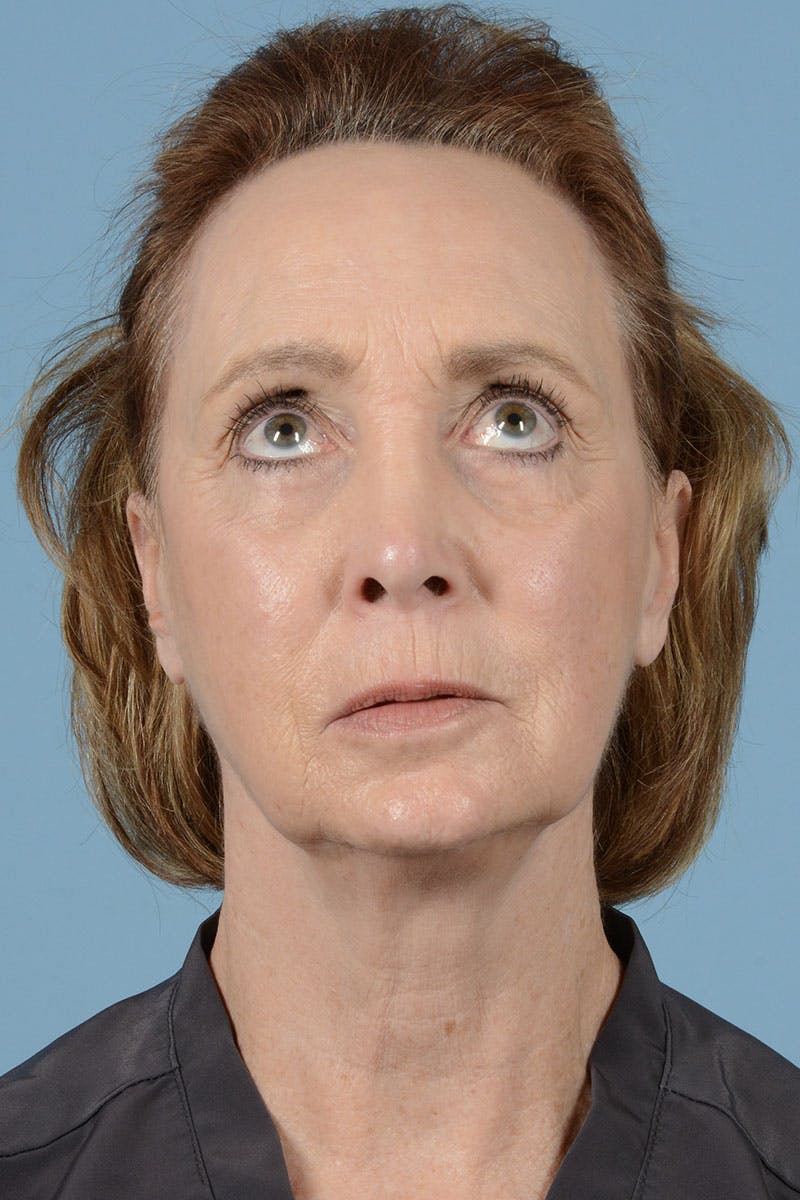 Facelift Before & After Gallery - Patient 187082 - Image 3