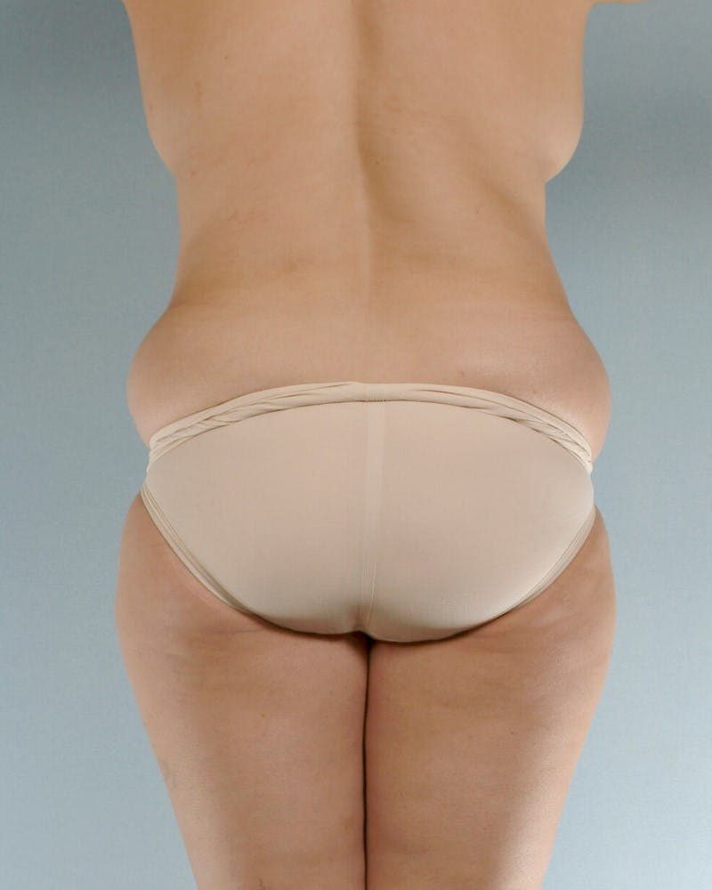 Tummy Tuck Before & After Gallery - Patient 251377 - Image 7