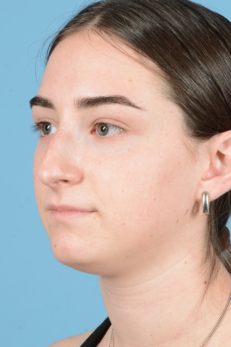 Rhinoplasty Before & After Gallery - Patient 126984 - Image 9