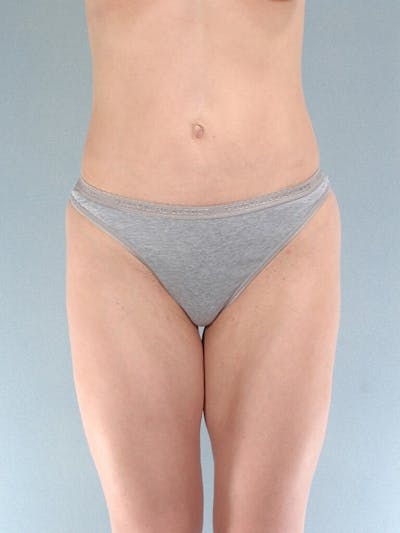 Liposuction Before & After Gallery - Patient 401997 - Image 2