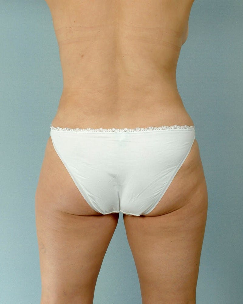 Tummy Tuck Before & After Gallery - Patient 251377 - Image 8