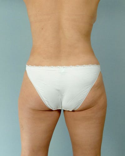 Tummy Tuck Before & After Gallery - Patient 251377 - Image 8