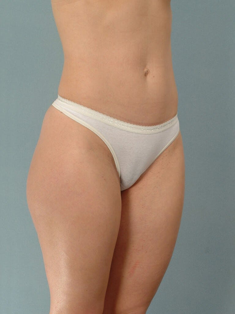 Liposuction Before & After Gallery - Patient 401997 - Image 3