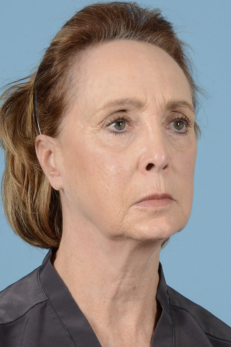 Facelift Before & After Gallery - Patient 187082 - Image 5
