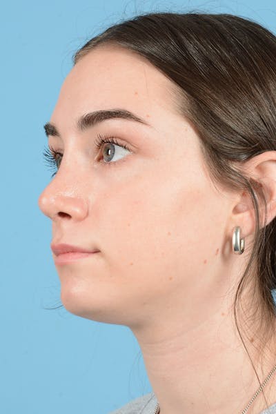 Rhinoplasty Before & After Gallery - Patient 126984 - Image 10