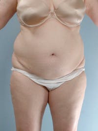 Tummy Tuck Before & After Gallery - Patient 354583 - Image 1