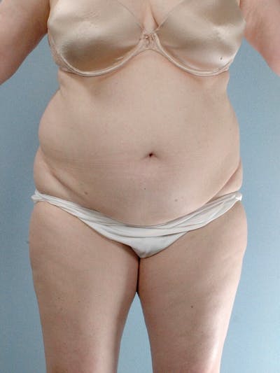 Tummy Tuck Before & After Gallery - Patient 354583 - Image 1