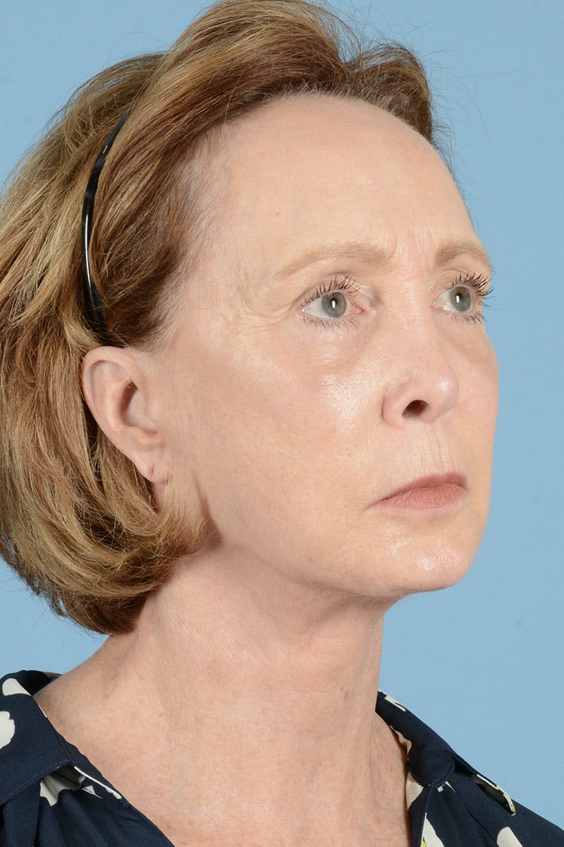 Facelift Before & After Gallery - Patient 187082 - Image 6