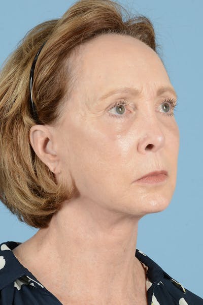 Facelift Before & After Gallery - Patient 187082 - Image 6