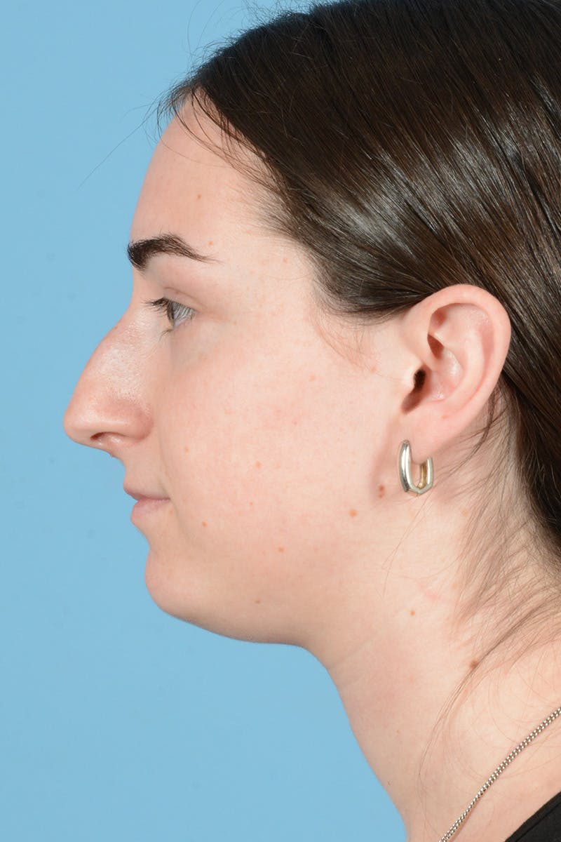 Rhinoplasty Before & After Gallery - Patient 126984 - Image 11