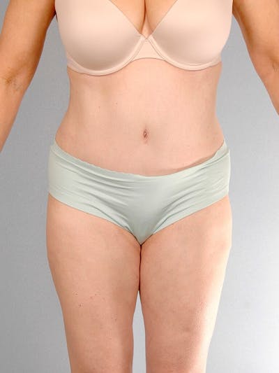 Tummy Tuck Before & After Gallery - Patient 354583 - Image 2