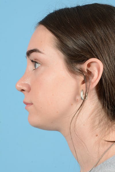 Rhinoplasty Before & After Gallery - Patient 126984 - Image 12