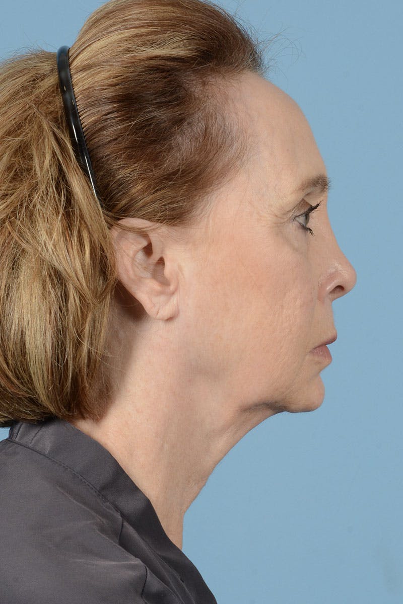 Facelift Before & After Gallery - Patient 187082 - Image 7