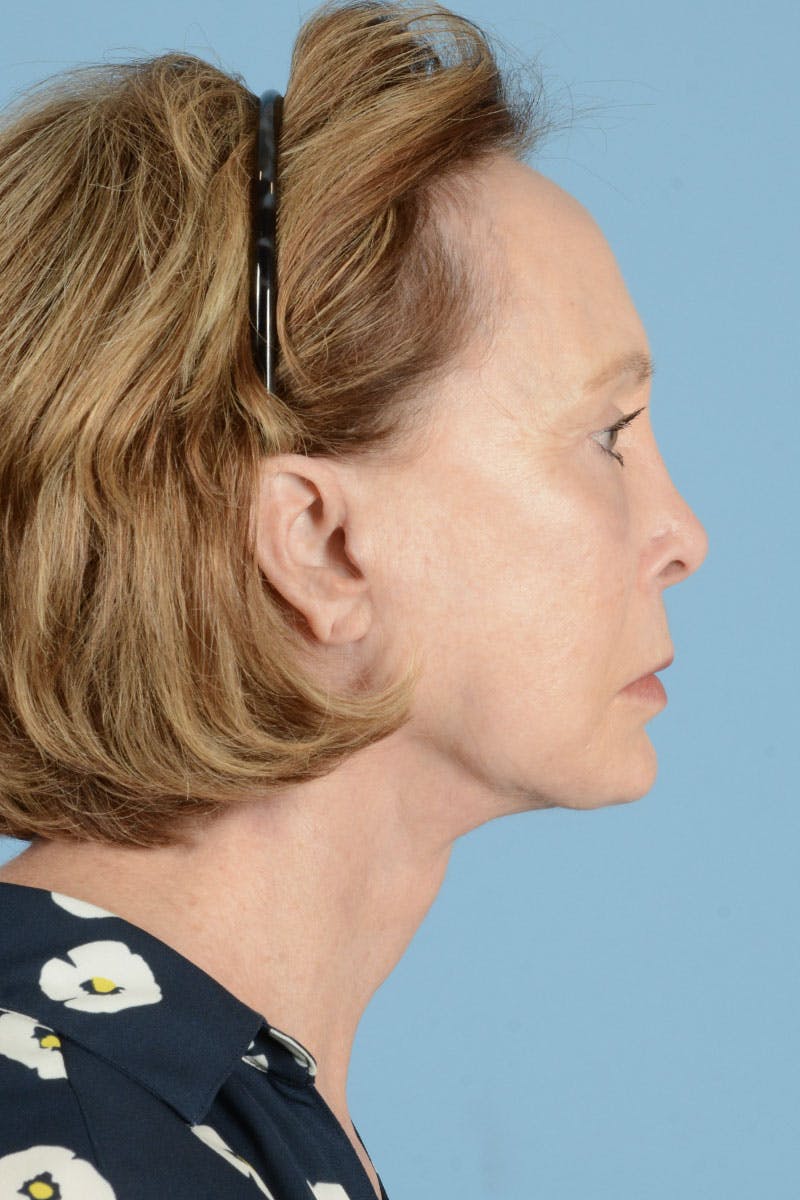 Facelift Before & After Gallery - Patient 187082 - Image 8