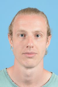 Rhinoplasty Before & After Gallery - Patient 270798 - Image 1