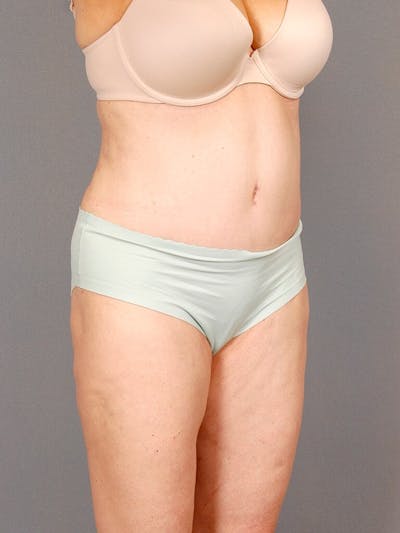 Tummy Tuck Before & After Gallery - Patient 354583 - Image 4