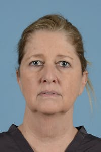 Facelift Before & After Gallery - Patient 346907 - Image 1