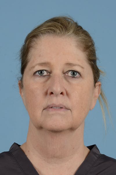 Facelift Before & After Gallery - Patient 346907 - Image 1