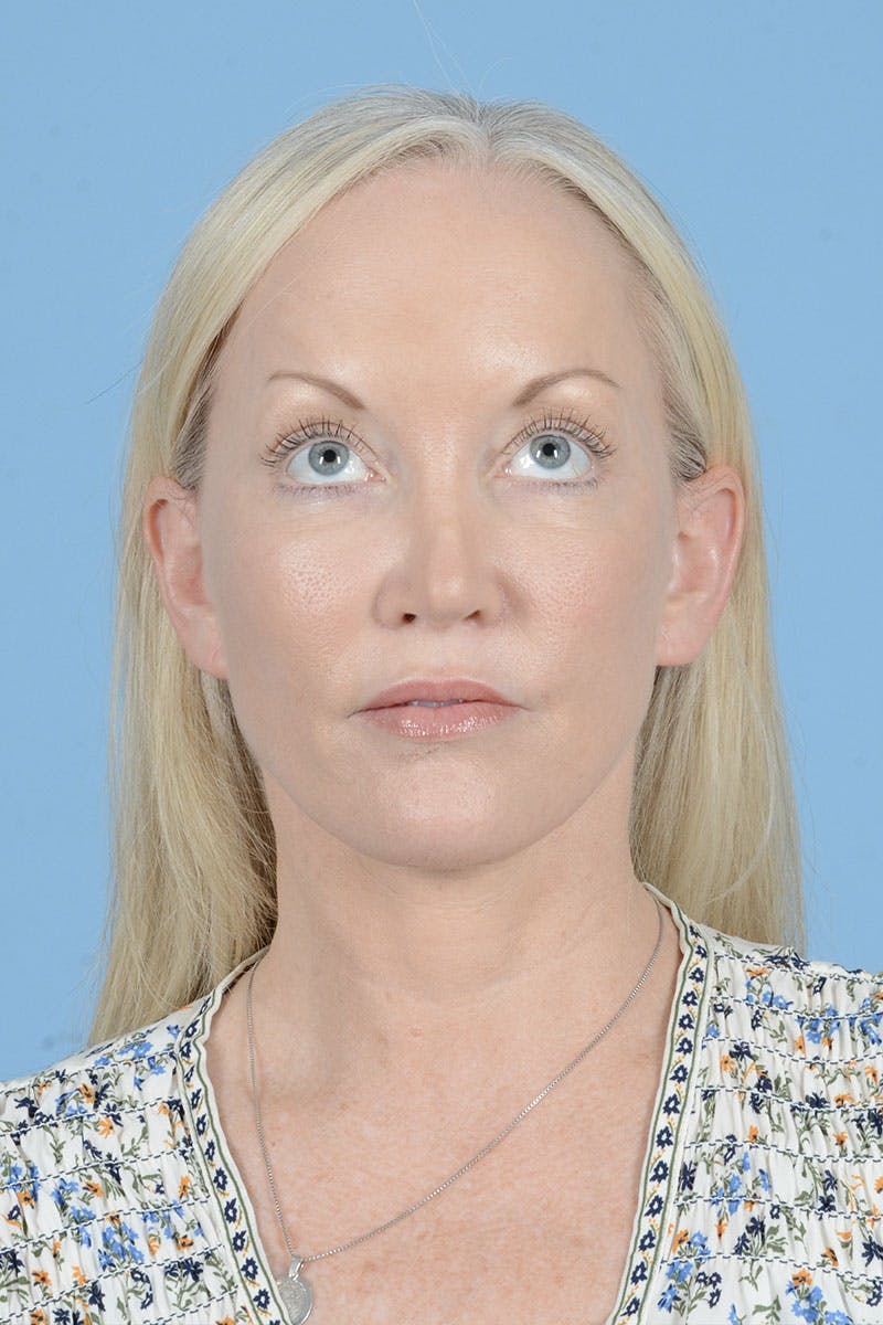 Neck Lift Before & After Gallery - Patient 311092 - Image 4