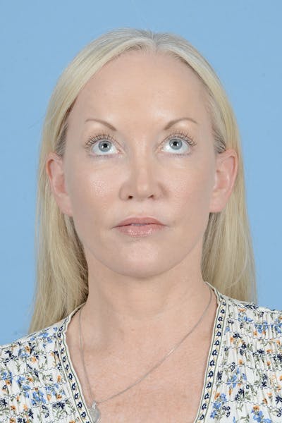 Neck Lift Before & After Gallery - Patient 311092 - Image 4