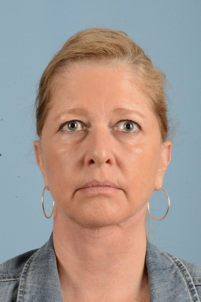 Facelift Before & After Gallery - Patient 346907 - Image 2