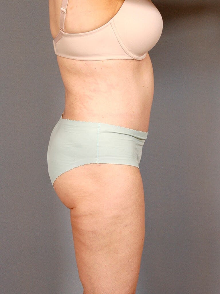 Tummy Tuck Before & After Gallery - Patient 354583 - Image 6