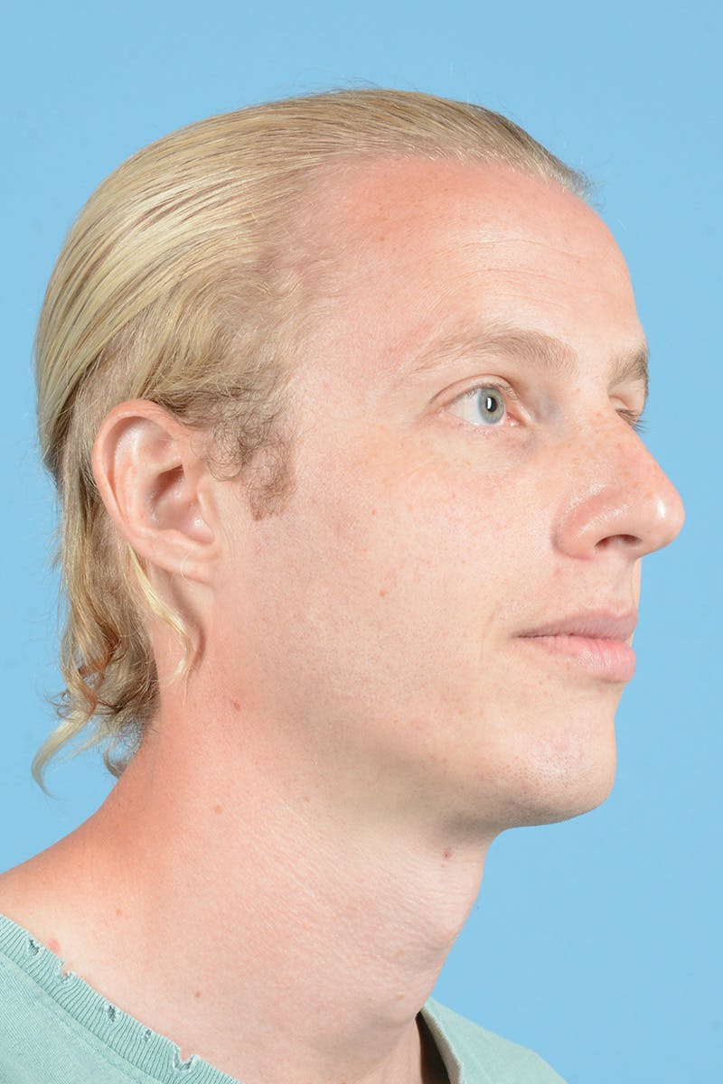 Rhinoplasty Before & After Gallery - Patient 270798 - Image 3
