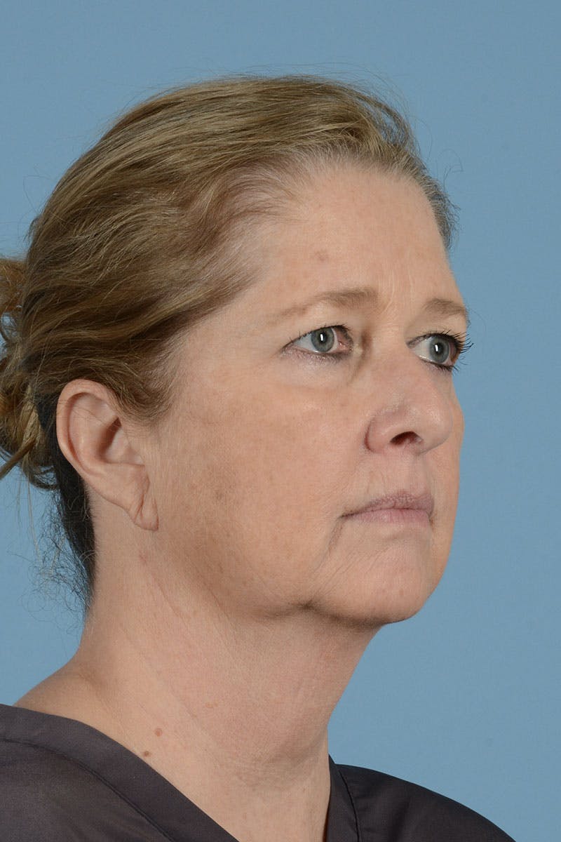 Facelift Before & After Gallery - Patient 346907 - Image 3