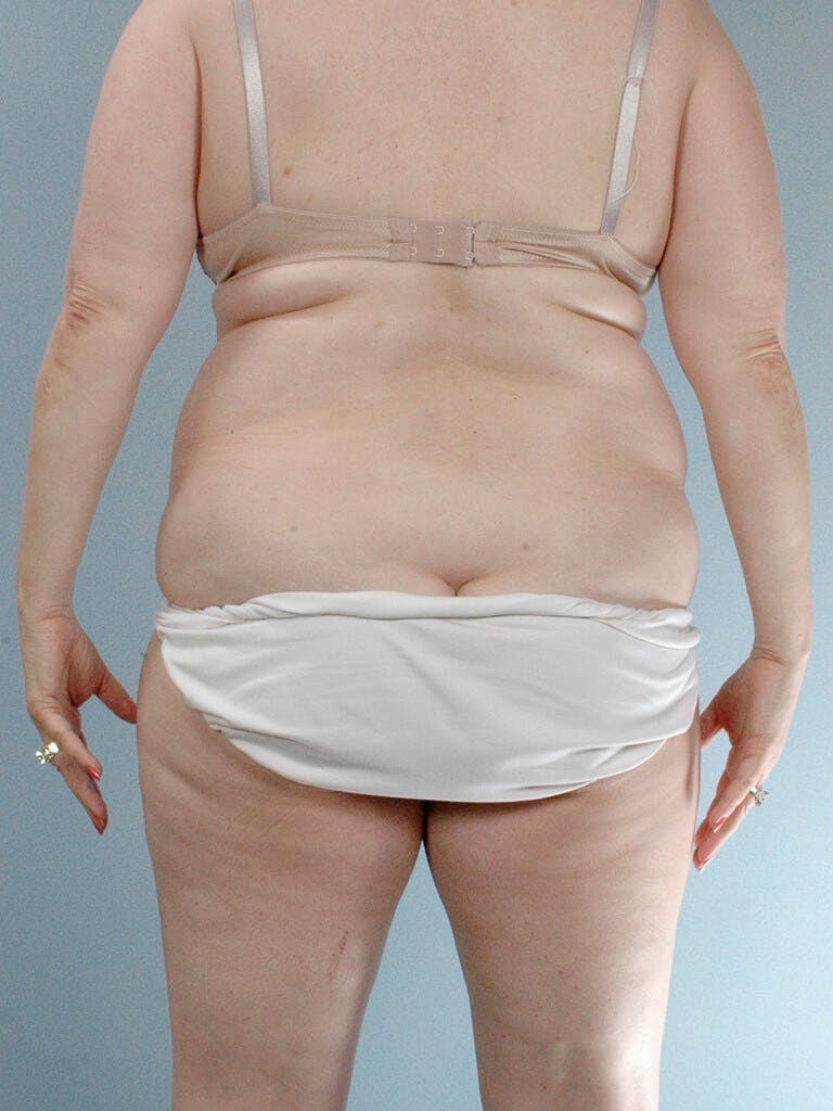 Tummy Tuck Before & After Gallery - Patient 354583 - Image 7