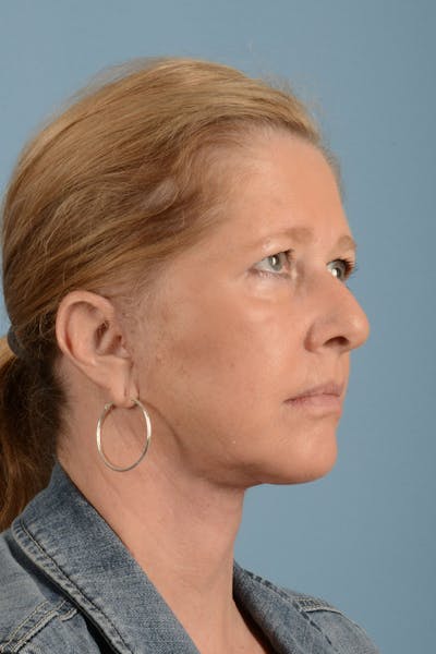 Facelift Before & After Gallery - Patient 346907 - Image 4