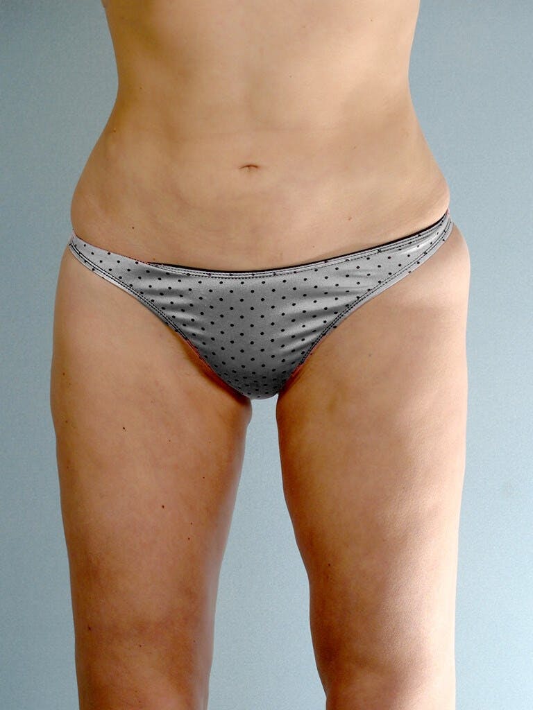 Liposuction Before & After Gallery - Patient 161150 - Image 2