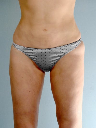 Liposuction Before & After Gallery - Patient 161150 - Image 2