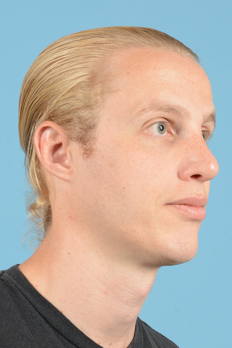 Rhinoplasty Before & After Gallery - Patient 270798 - Image 4