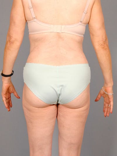 Tummy Tuck Before & After Gallery - Patient 354583 - Image 8