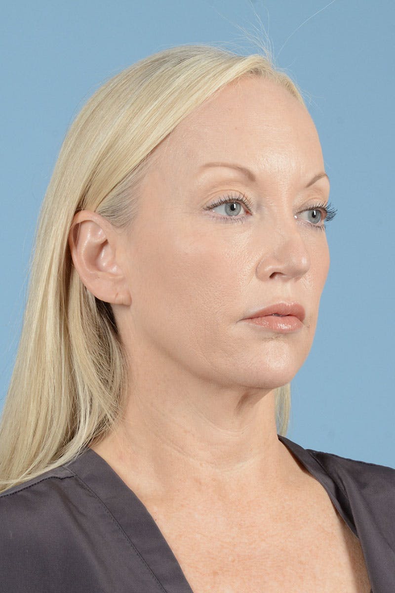 Neck Lift Before & After Gallery - Patient 311092 - Image 7