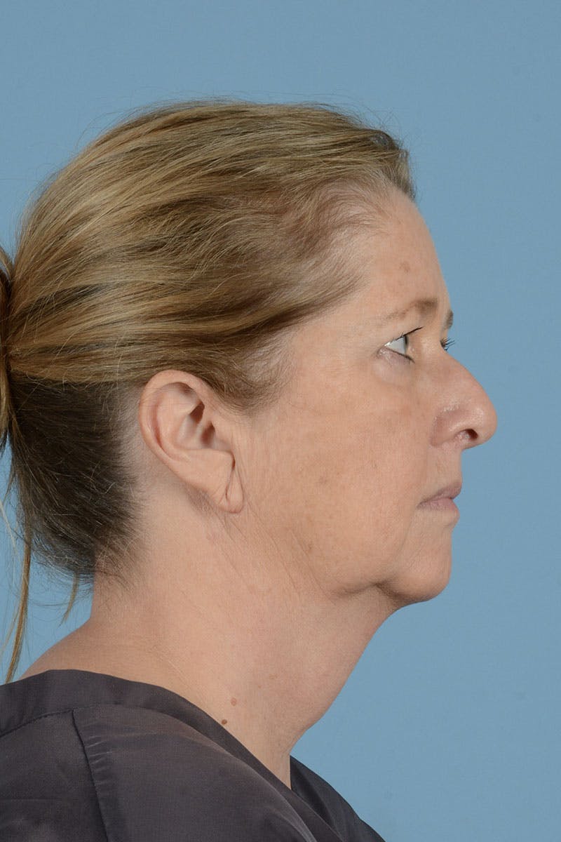 Facelift Before & After Gallery - Patient 346907 - Image 5