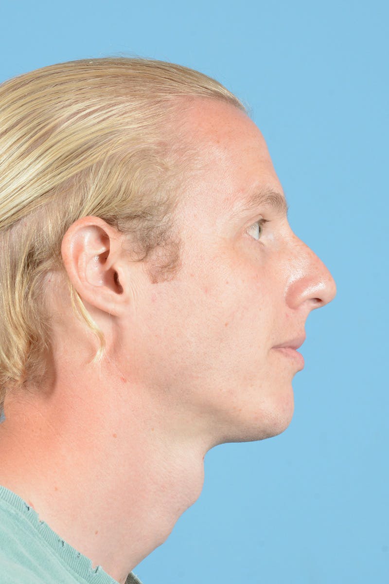 Rhinoplasty Before & After Gallery - Patient 270798 - Image 5